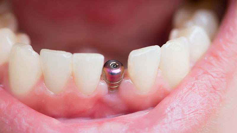 Dental Implants in Bloomington, IN